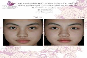 Under Eye Filler