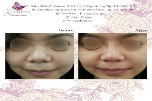 Filler Hidung / Nose Filler