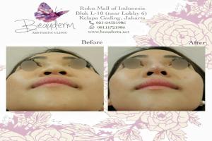 Filler Hidung / Nose Filler