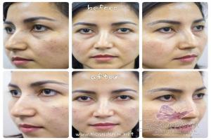 Under Eye Filler