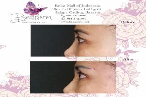 Filler Hidung / Nose Filler