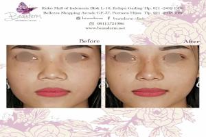 Filler Hidung / Nose Filler