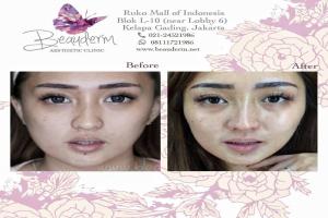 Tarik Benang (Threadlift)