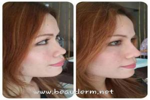 Filler Hidung / Nose Filler