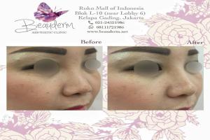 Filler Hidung / Nose Filler