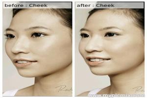 Cheek Augmentation / Filler Pipi