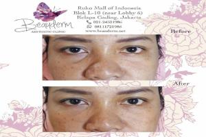 Under Eye Filler
