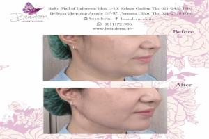 Tarik Benang (Threadlift)