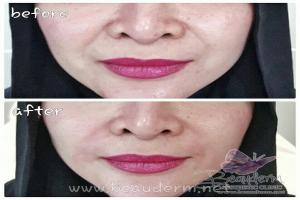 Smile Line Filler