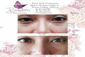 Under Eye Filler