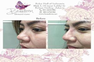 Filler Hidung / Nose Filler