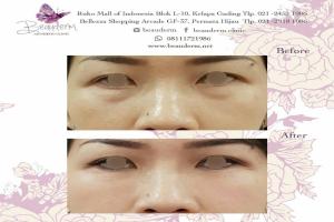 Under Eye Filler
