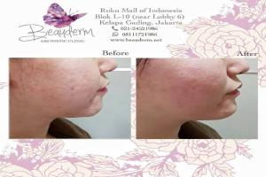 Chin Augmentation / Filler Dagu
