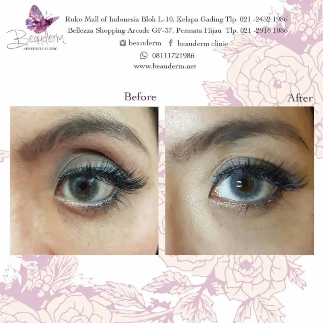 Upper Eyelid Filler