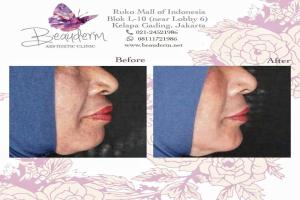 Chin Augmentation / Filler Dagu