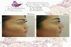 Filler Hidung / Nose Filler