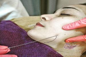 Tarik Benang (Threadlift)
