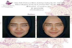 Tarik Benang (Threadlift)