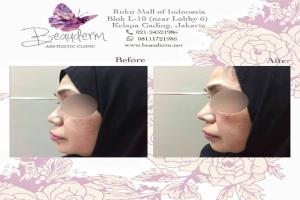 Filler Hidung / Nose Filler