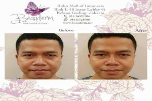 Filler Hidung / Nose Filler