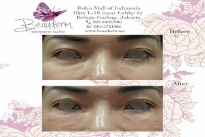 Under Eye Filler