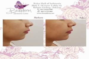 Chin Augmentation / Filler Dagu