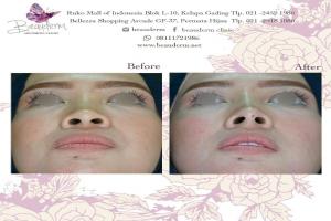 Tarik Benang (Threadlift)