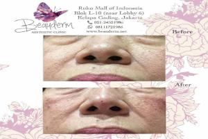 Filler Hidung / Nose Filler