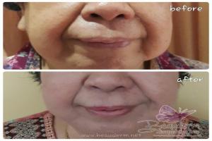 Tarik Benang (Threadlift)
