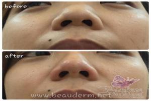Filler Hidung / Nose Filler