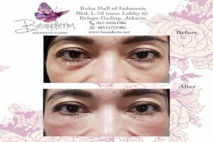 Under Eye Filler