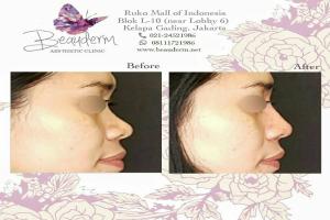 Filler Hidung / Nose Filler
