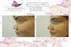 Filler Hidung / Nose Filler