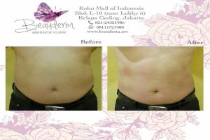 Slimming