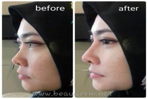 Filler Hidung / Nose Filler