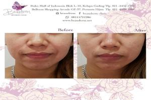 Chin Augmentation / Filler Dagu