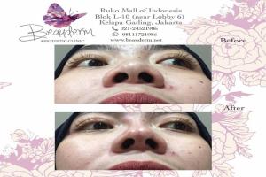 Filler Hidung / Nose Filler