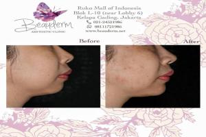 Chin Augmentation / Filler Dagu
