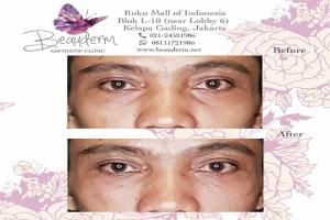Under Eye Filler