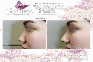 Filler Hidung / Nose Filler