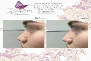 Filler Hidung / Nose Filler