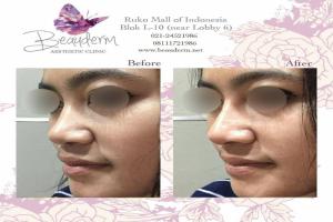 Tarik Benang (Threadlift)