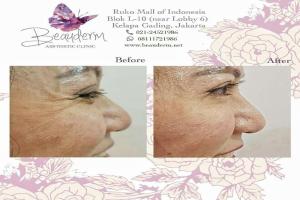 Under Eye Filler