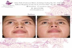 Filler Hidung / Nose Filler