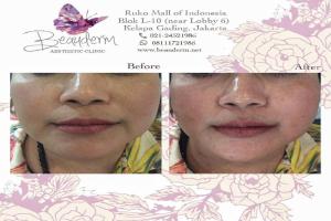 Smile Line Filler