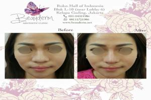 Filler Hidung / Nose Filler
