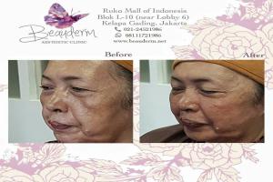 Mid Face Filler