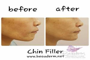 Chin Augmentation / Filler Dagu