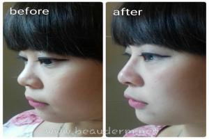 Filler Hidung / Nose Filler