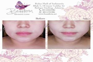 Tarik Benang (Threadlift)